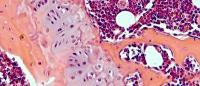 Microscopic image of a musculoskeletal oncology pathology sample.